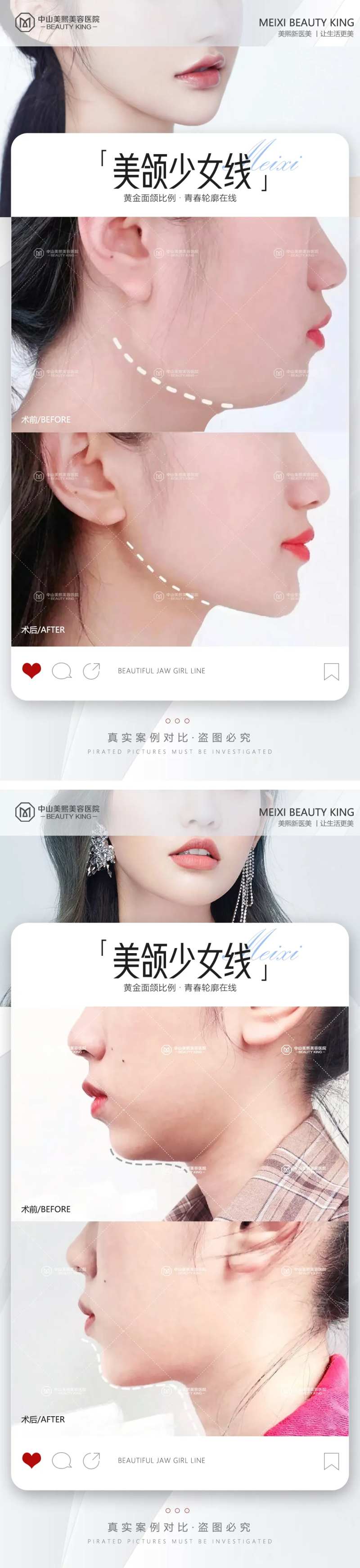 下颌线案例海报-采灵感-cailinggan.com