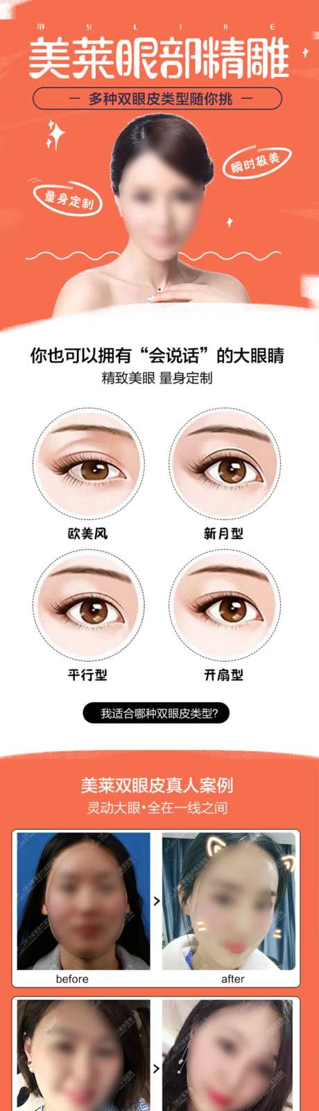 医美双眼皮类型详情页-采灵感-https://www.cailinggan.com/