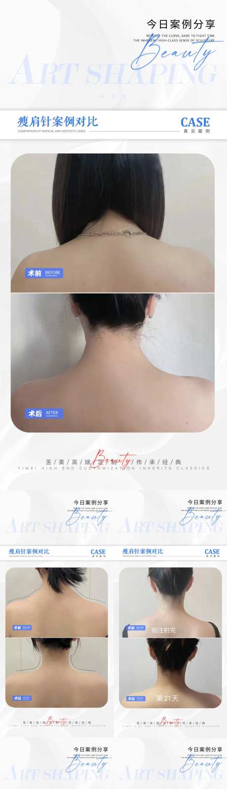 医美瘦肩针案例对比海报-采灵感-https://www.cailinggan.com/