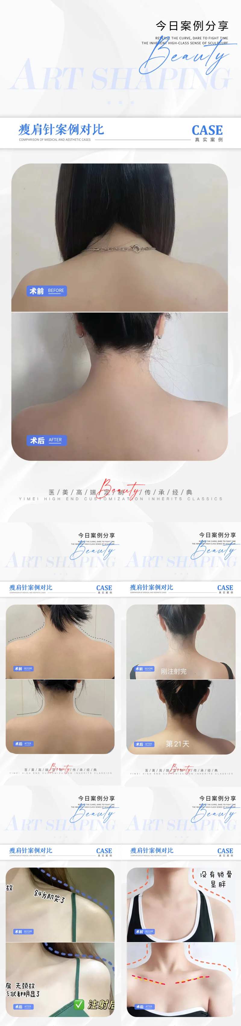 医美瘦肩针案例对比海报-采灵感-cailinggan.com