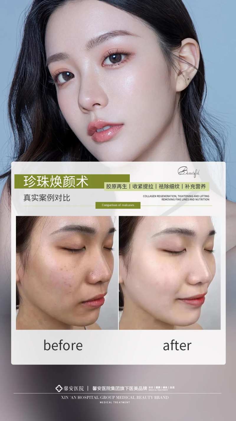 医美水光针案例对比图海报-采灵感-cailinggan.com