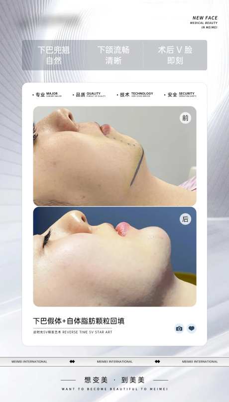 下巴假体 -采灵感-https://www.cailinggan.com/