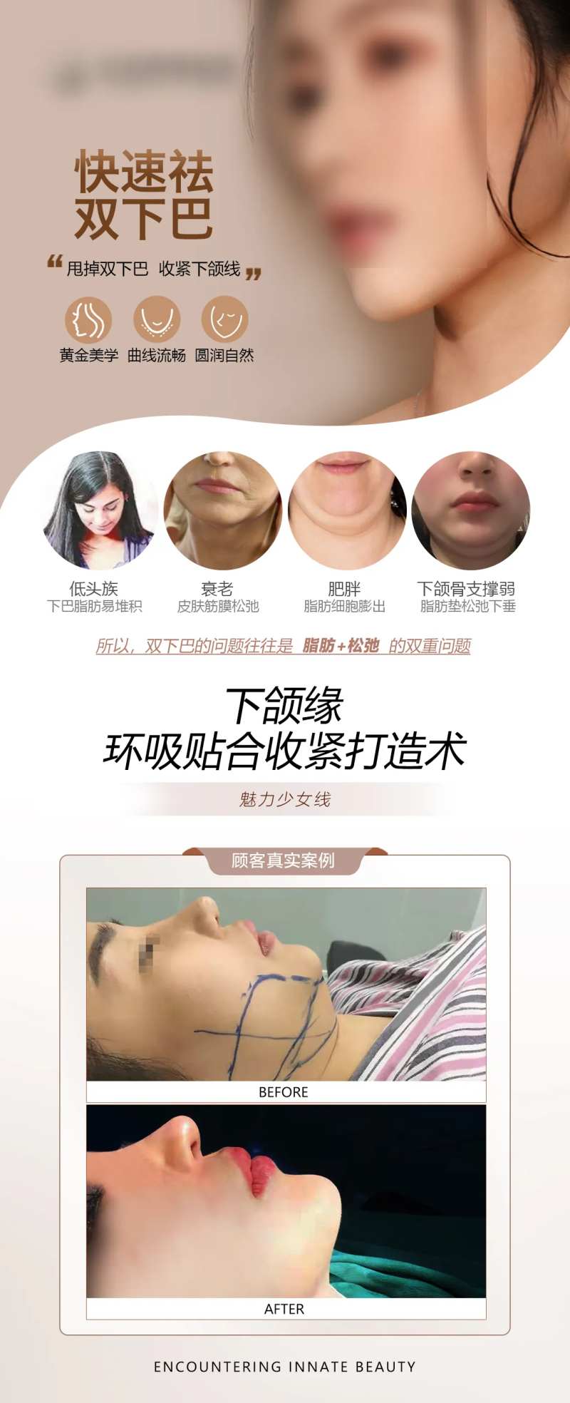 医美双下巴吸脂案例对比-采灵感-cailinggan.com
