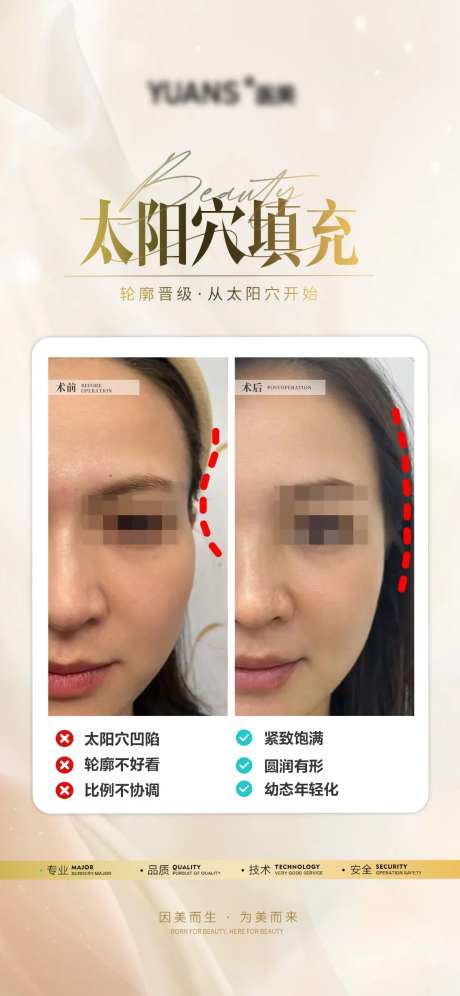医美太阳穴案例-采灵感-https://www.cailinggan.com/
