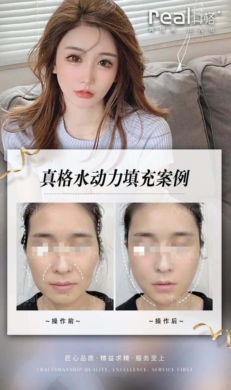 医美案例对比图-采灵感-cailinggan.com