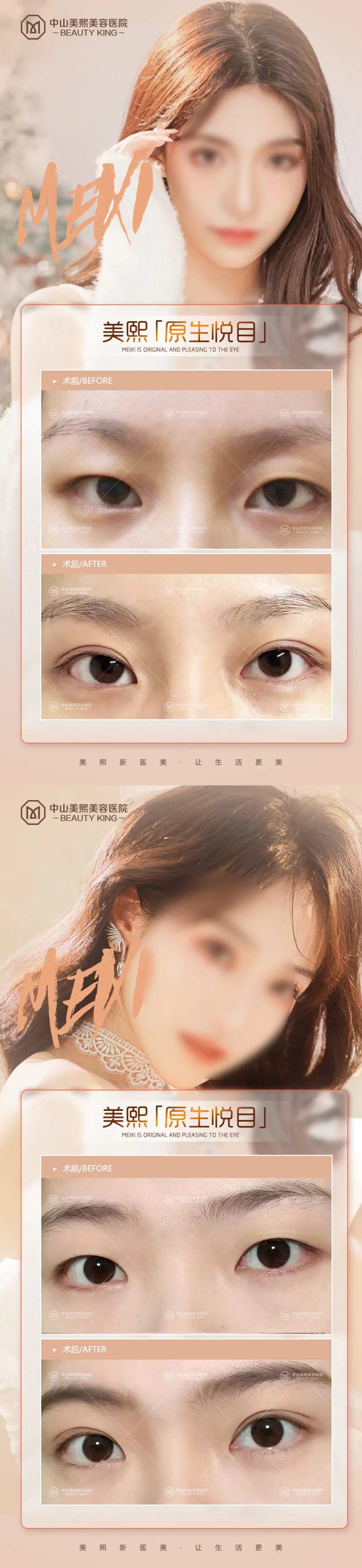 双眼皮案例海报-采灵感-cailinggan.com