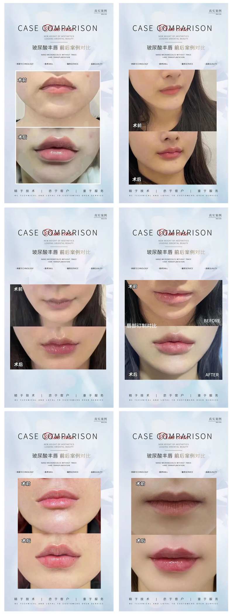 医美整形丰唇案例分享系列海报-采灵感-cailinggan.com