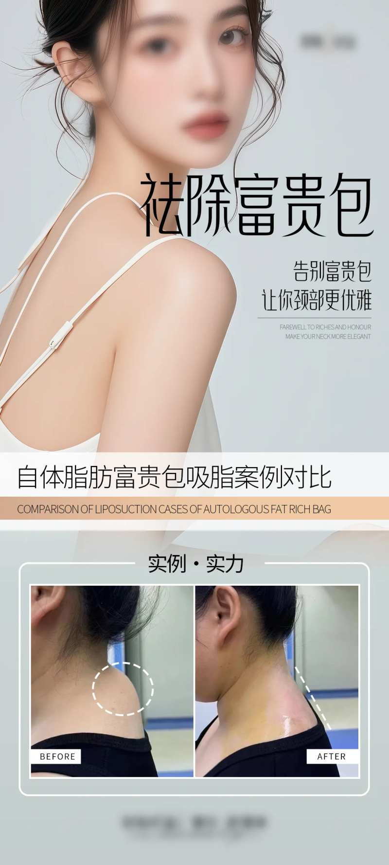 祛除富贵包案例海报-采灵感-cailinggan.com