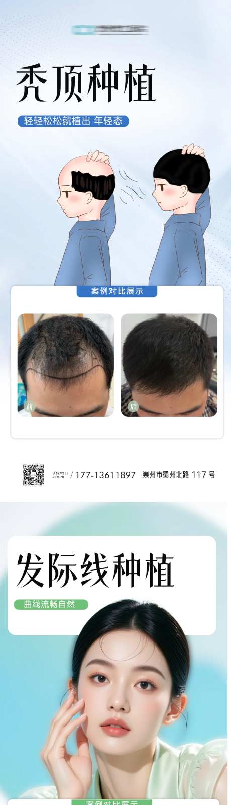 发际线秃顶植发案例海报-采灵感-https://www.cailinggan.com/