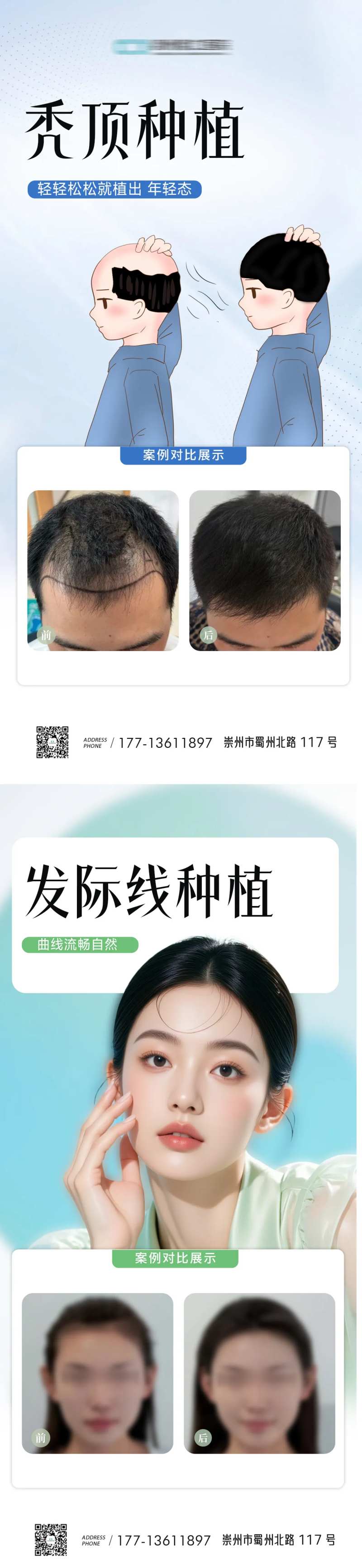 发际线秃顶植发案例海报-采灵感-cailinggan.com