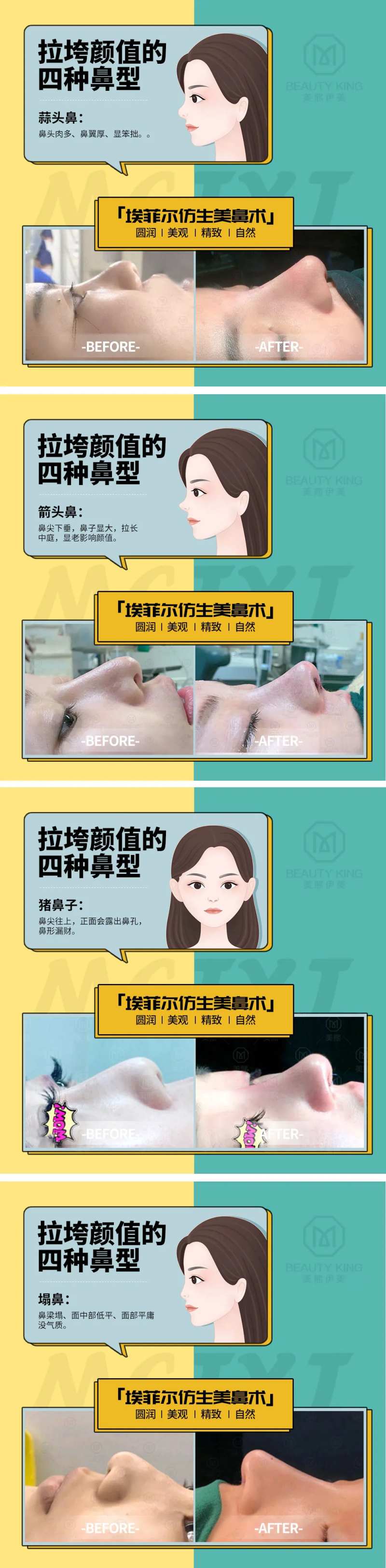 隆鼻助推海报-采灵感-cailinggan.com