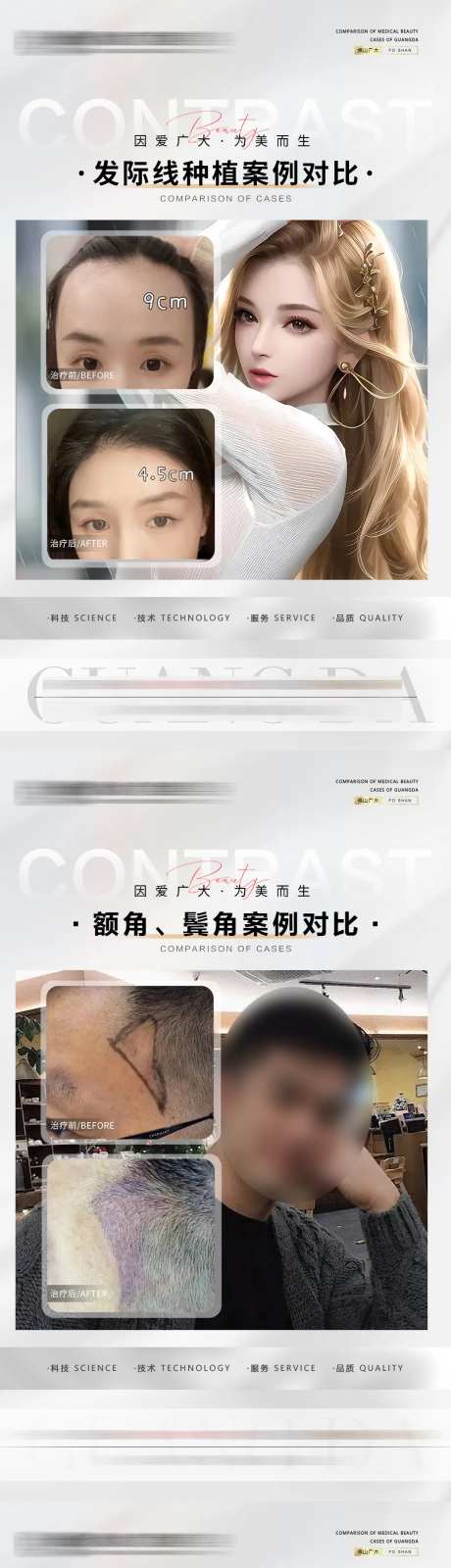 植发案例海报-采灵感-https://www.cailinggan.com/