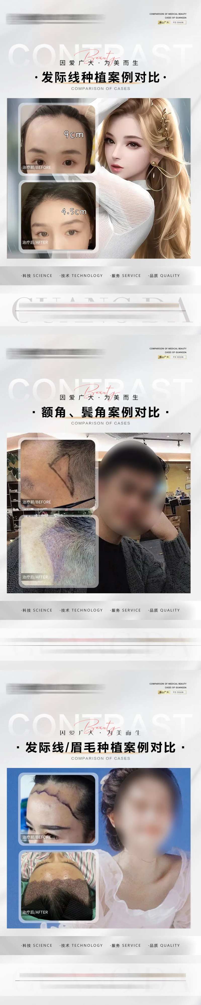 植发案例海报-采灵感-cailinggan.com