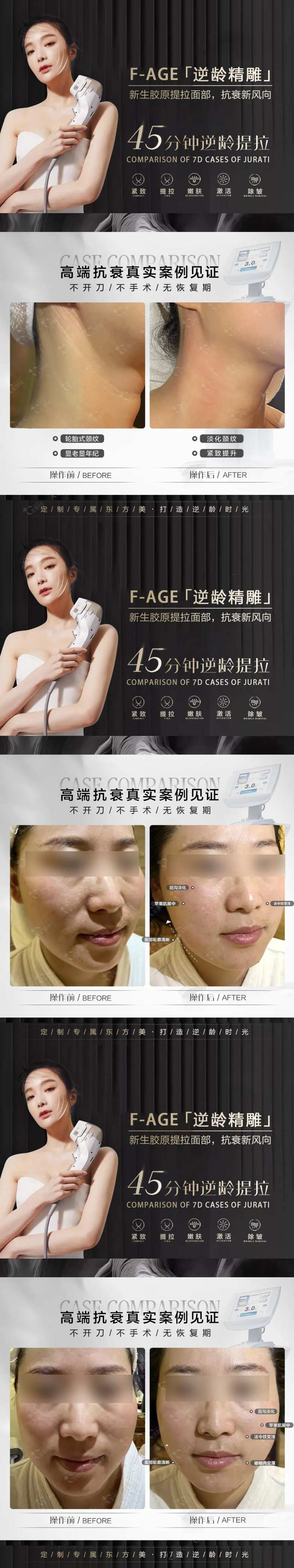 医美人物海报 7d光电案例海报-采灵感-cailinggan.com