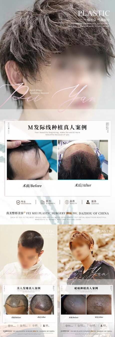 植发案例系列海报-采灵感-https://www.cailinggan.com/