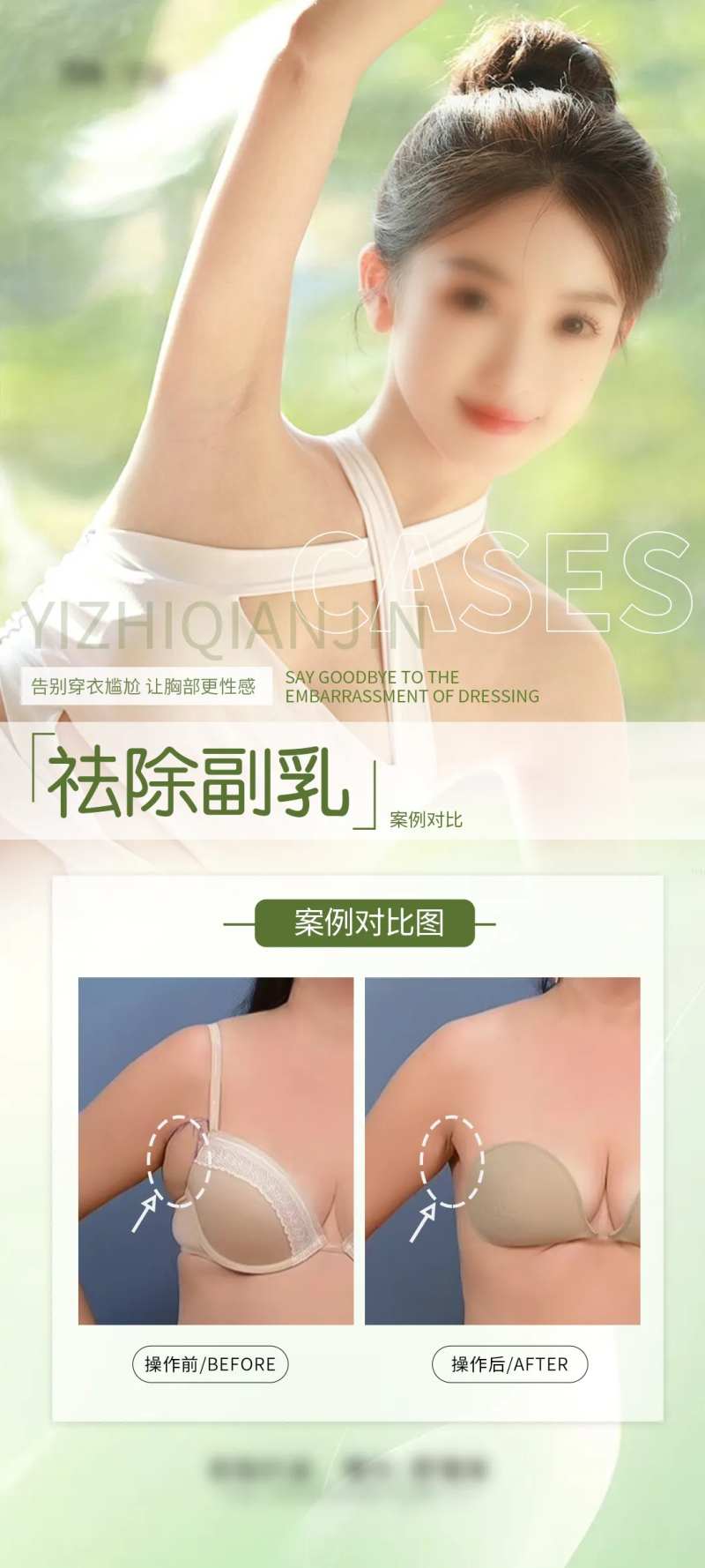 祛除副乳案例海报-采灵感-cailinggan.com