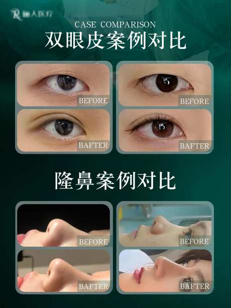 医美双眼皮隆鼻整形案例对比海报-采灵感-cailinggan.com