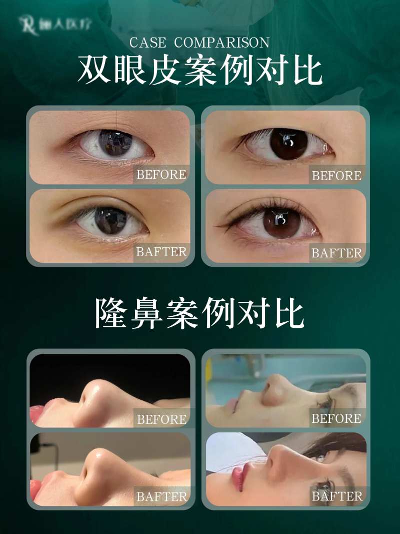 医美双眼皮隆鼻整形案例对比海报-采灵感-cailinggan.com