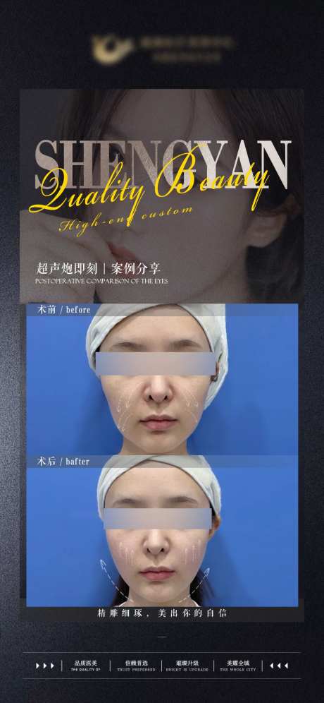 超声炮术前术后对比案例海报可更换-采灵感-https://www.cailinggan.com/