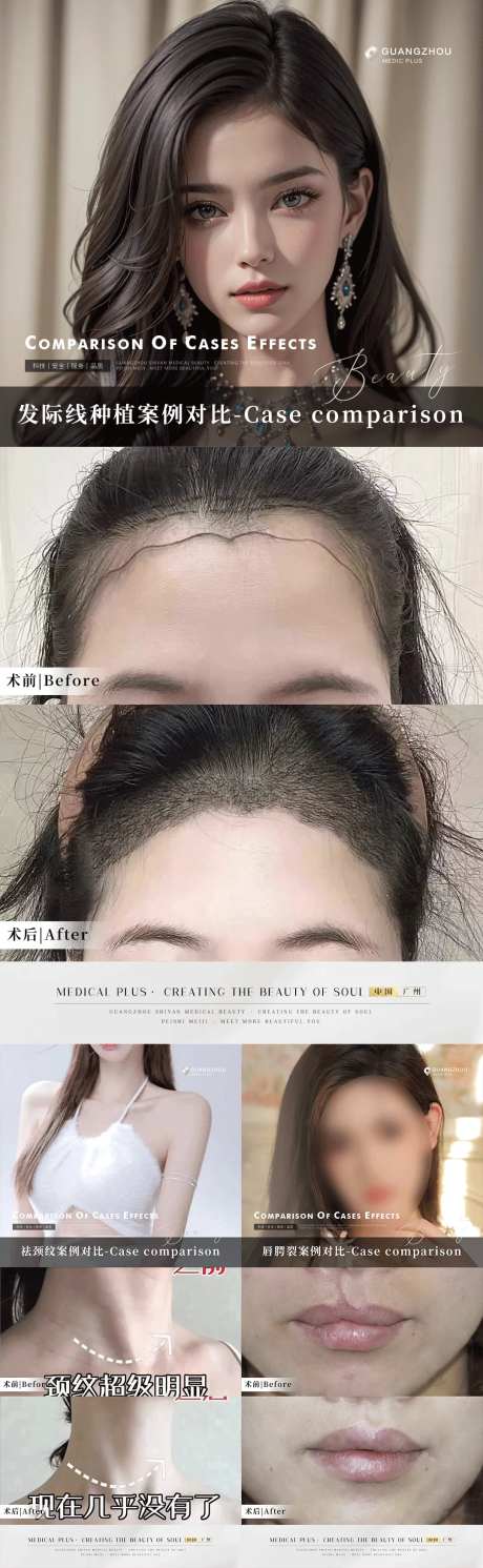 医美植发整形案例对比系列海报-采灵感-https://www.cailinggan.com/