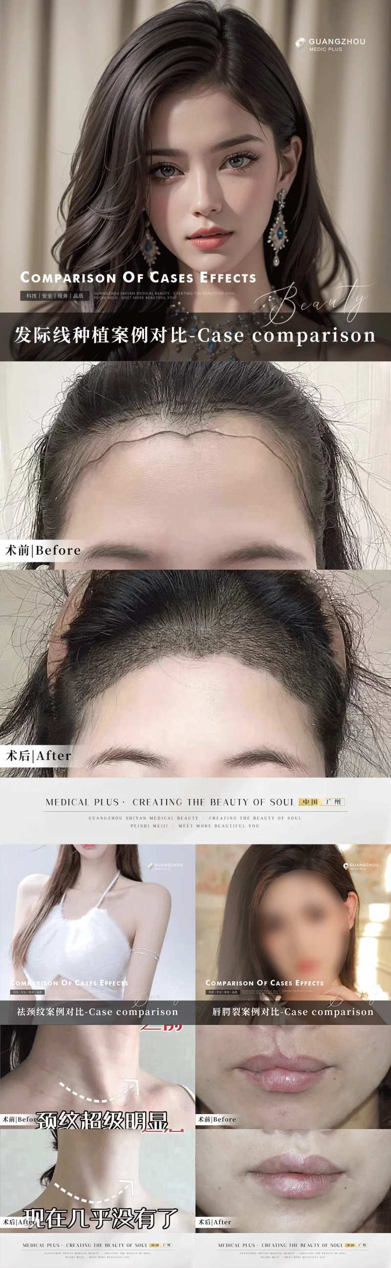 医美植发整形案例对比系列海报-采灵感-cailinggan.com