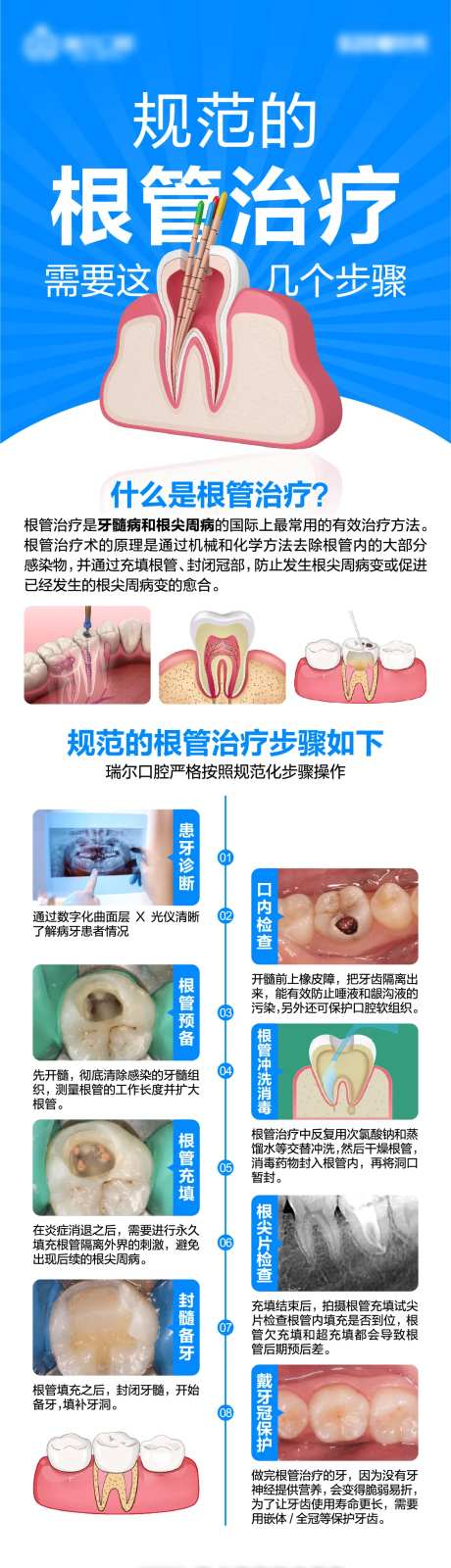 根管治疗流程-采灵感-https://www.cailinggan.com/