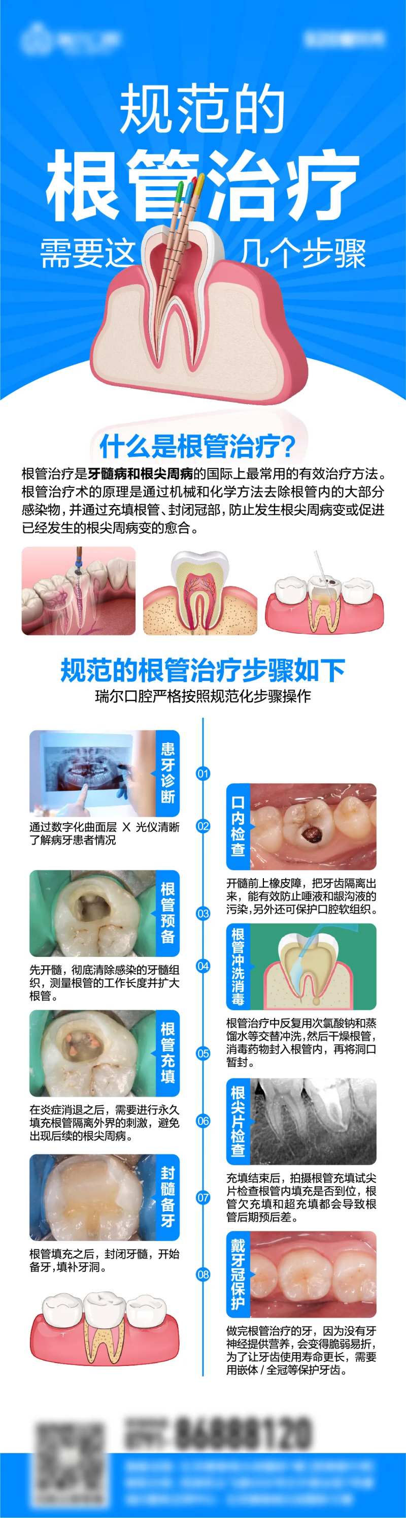 根管治疗流程-采灵感-cailinggan.com