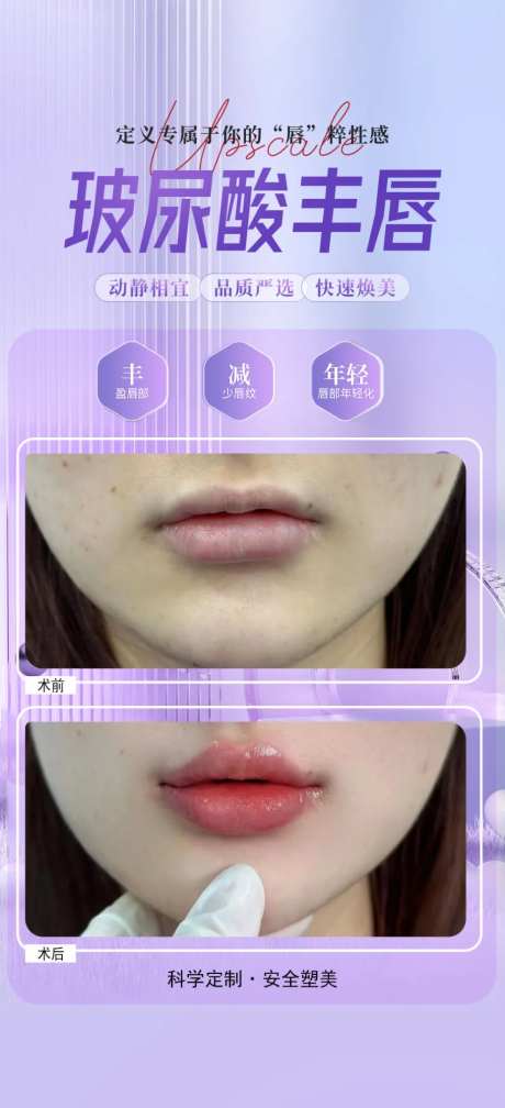 玻尿酸丰唇案例海报-采灵感-https://www.cailinggan.com/