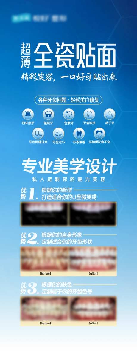 全瓷贴面口腔长图-采灵感-https://www.cailinggan.com/