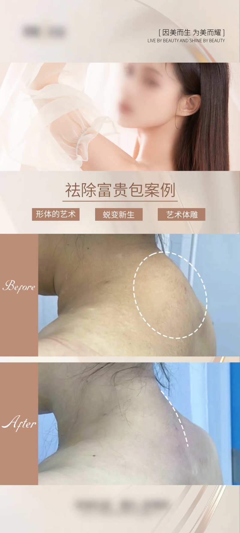 医美祛除富贵包案例海报-采灵感-cailinggan.com