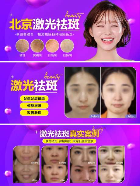 激光祛斑banner案例轮播图-采灵感-https://www.cailinggan.com/