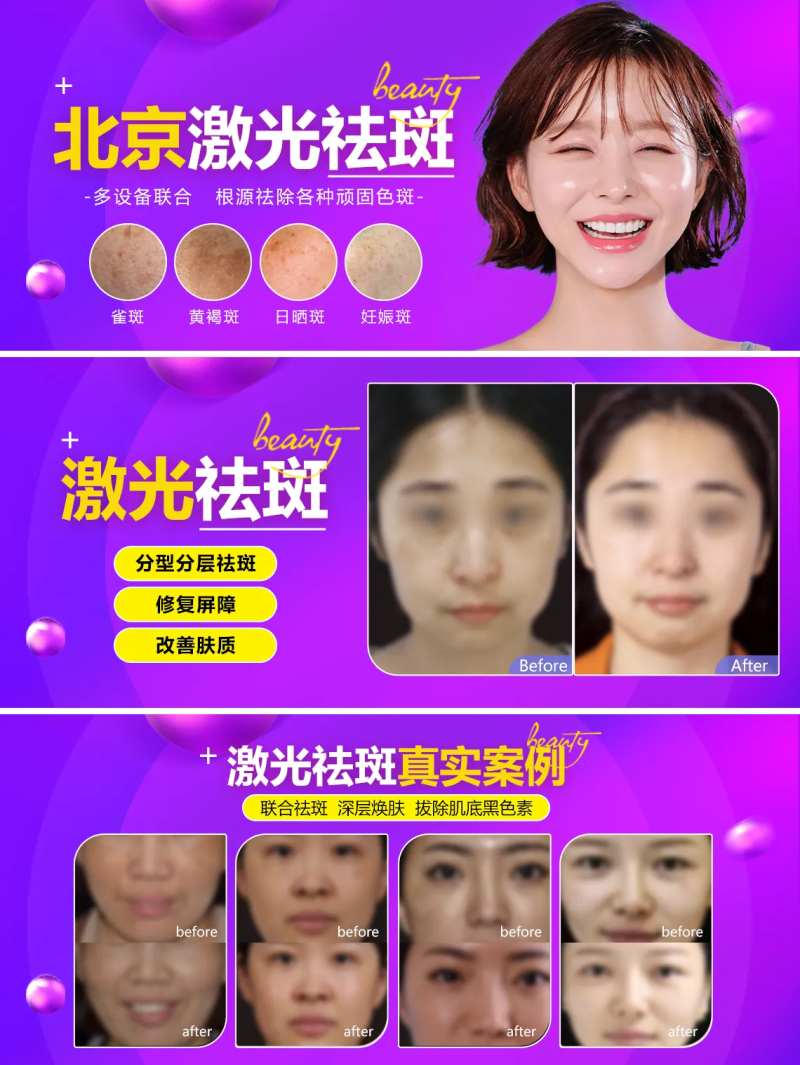 激光祛斑banner案例轮播图-采灵感-cailinggan.com