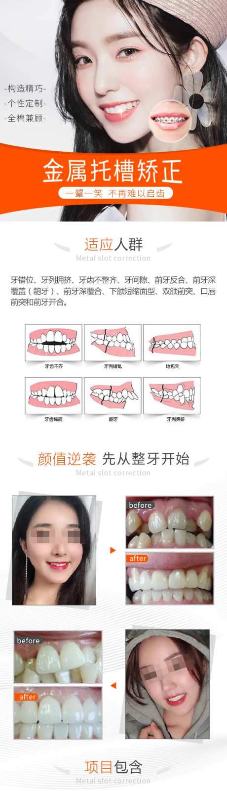 金属托槽矫正详情页-采灵感-https://www.cailinggan.com/