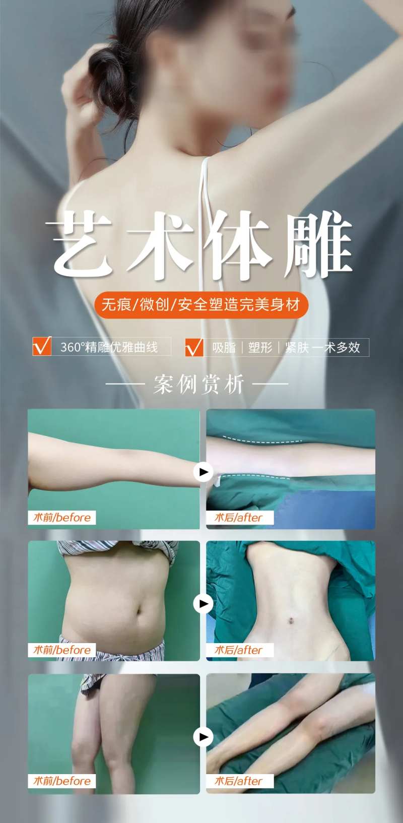 吸脂塑形艺术体雕案例海报-采灵感-cailinggan.com