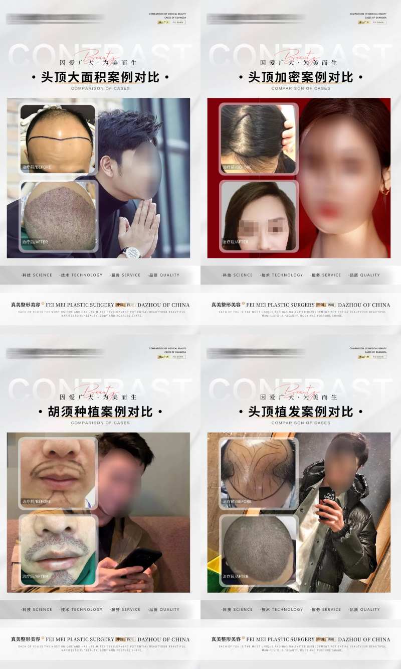 植发案例合集海报-采灵感-cailinggan.com