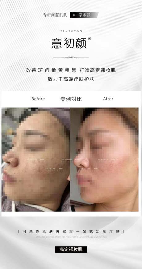 长沙医美美容祛斑美白痘痘模特对比简约-采灵感-https://www.cailinggan.com/