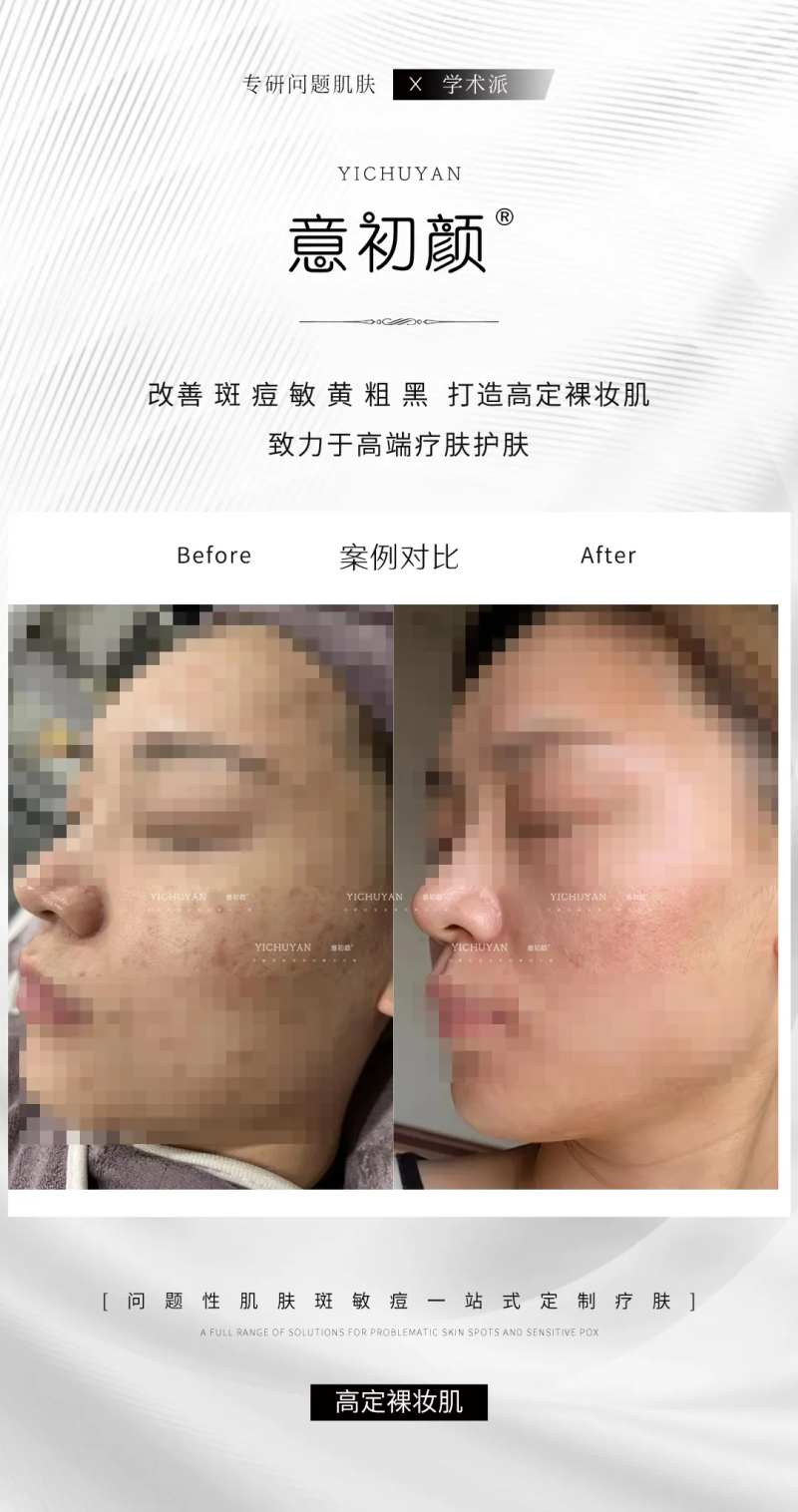 长沙医美美容祛斑美白痘痘模特对比简约-采灵感-cailinggan.com