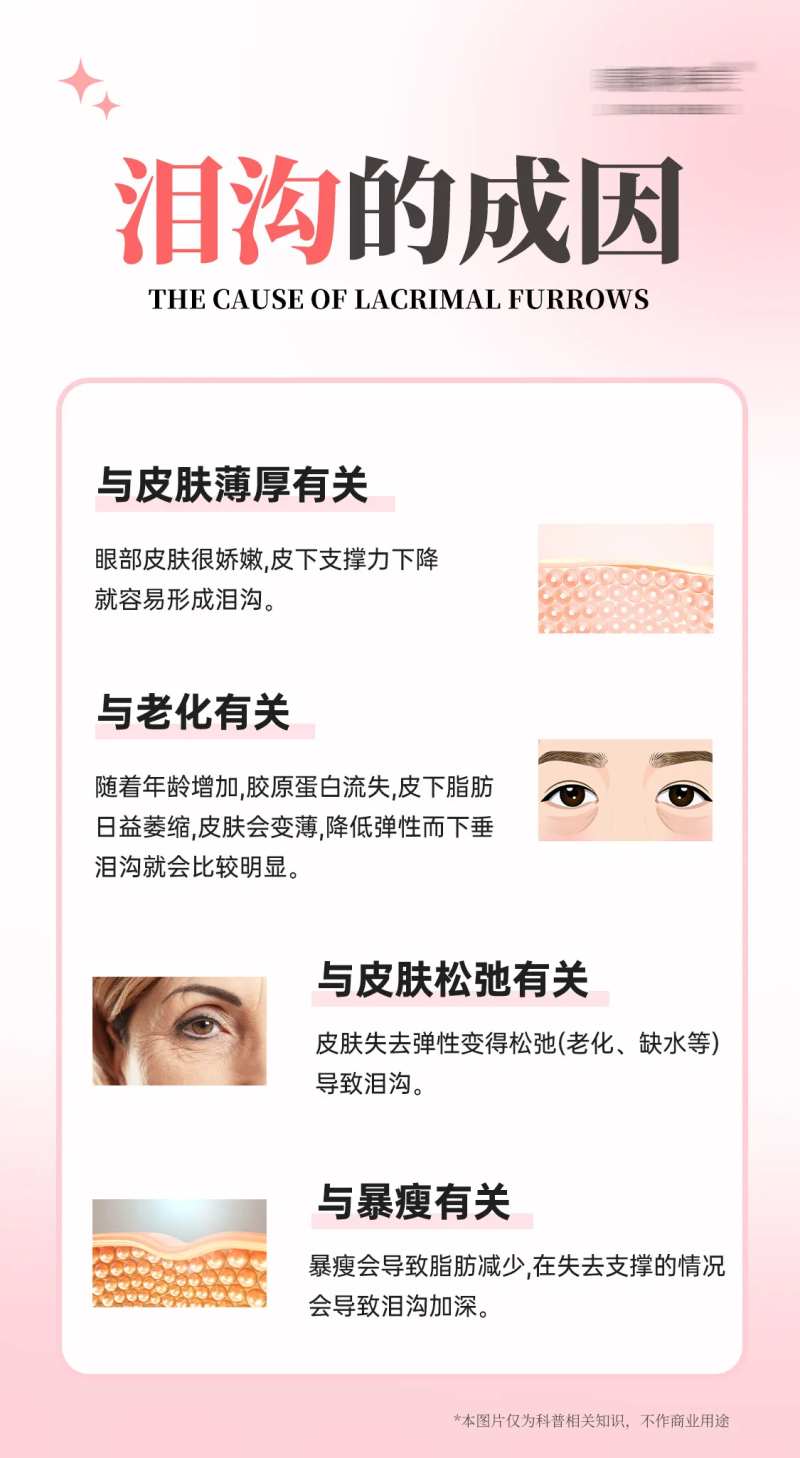 泪沟的成因医美海报-采灵感-cailinggan.com