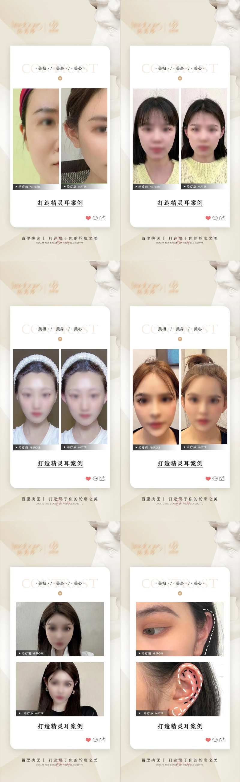 医美精灵耳案例分享-采灵感-cailinggan.com