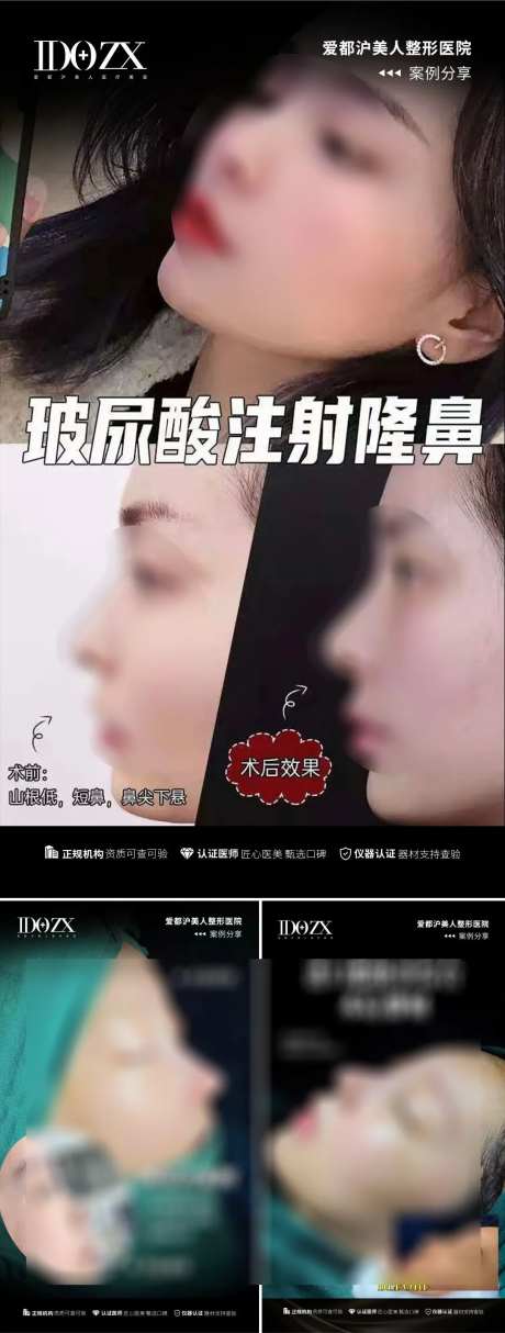医美鼻综合案例海报-采灵感-https://www.cailinggan.com/