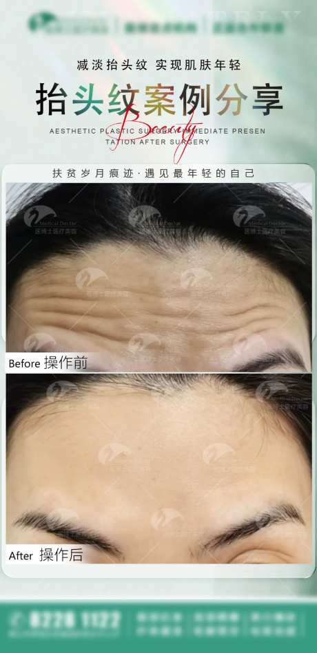 医美案例抬头纹宣传海报-采灵感-https://www.cailinggan.com/