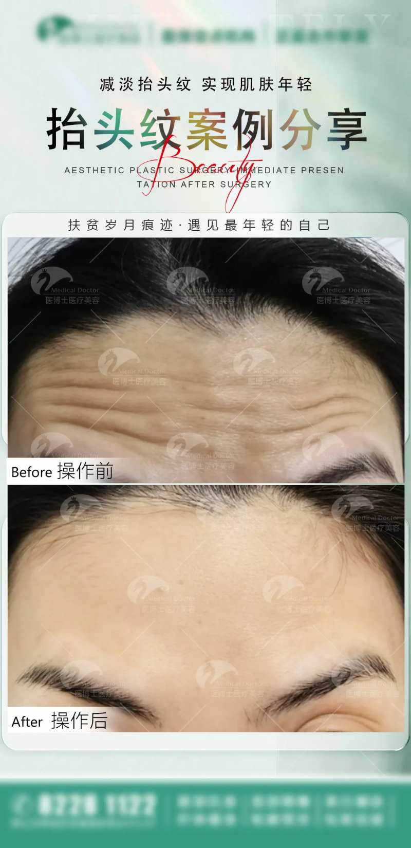 医美案例抬头纹宣传海报-采灵感-cailinggan.com