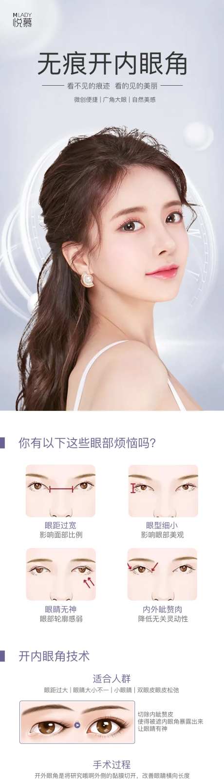 医美开内眼角科普详情-采灵感-https://www.cailinggan.com/