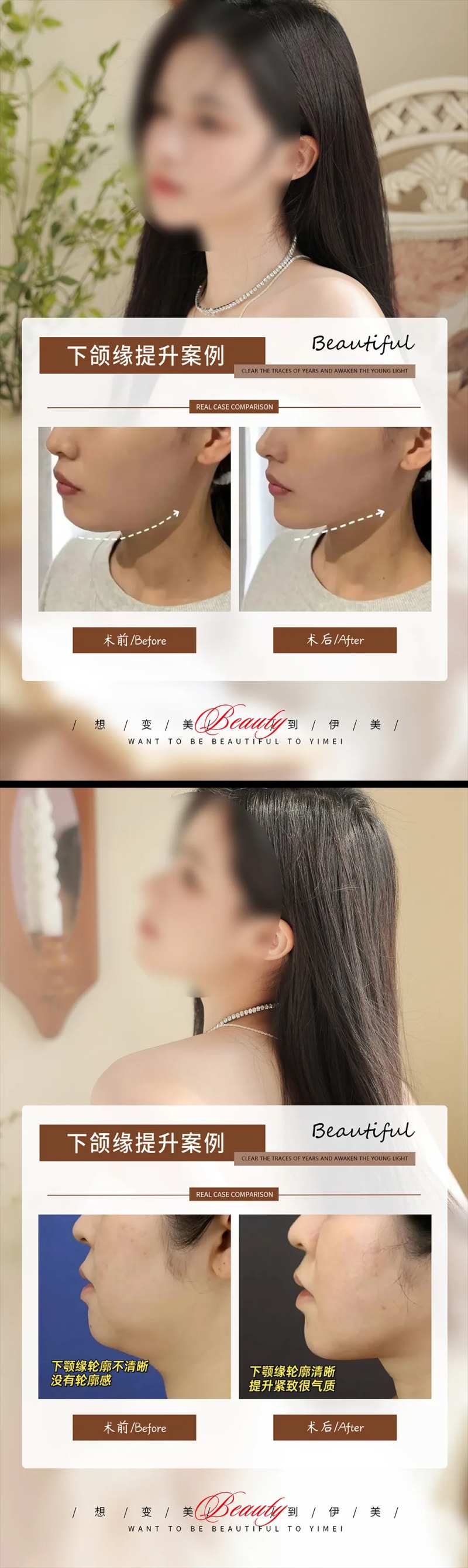 下颌线提升案例-采灵感-cailinggan.com