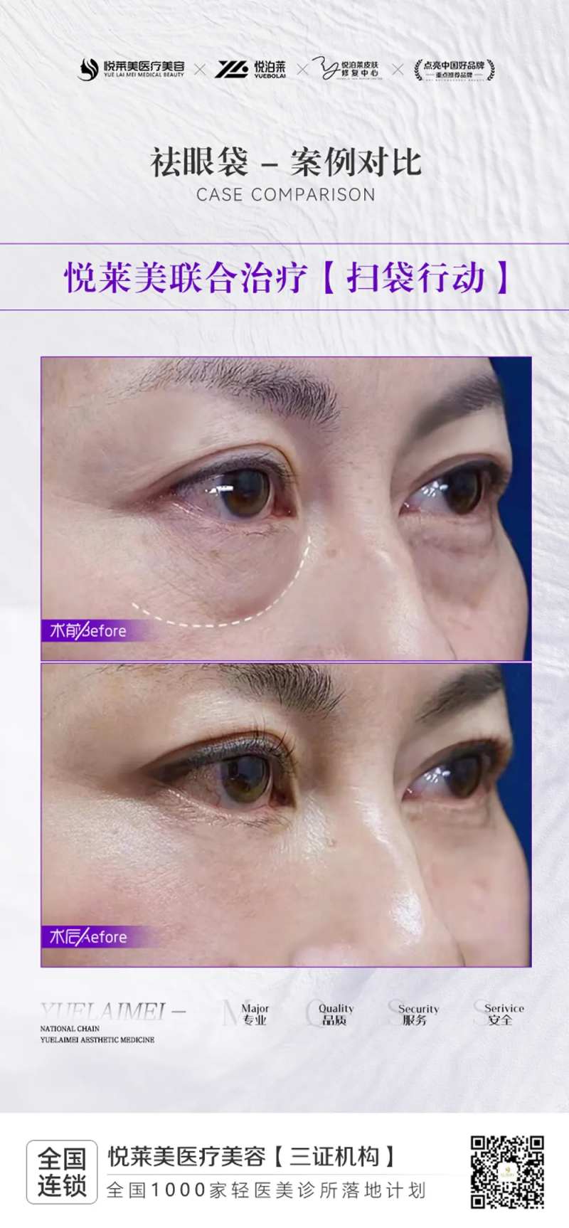 祛眼袋案例-采灵感-cailinggan.com