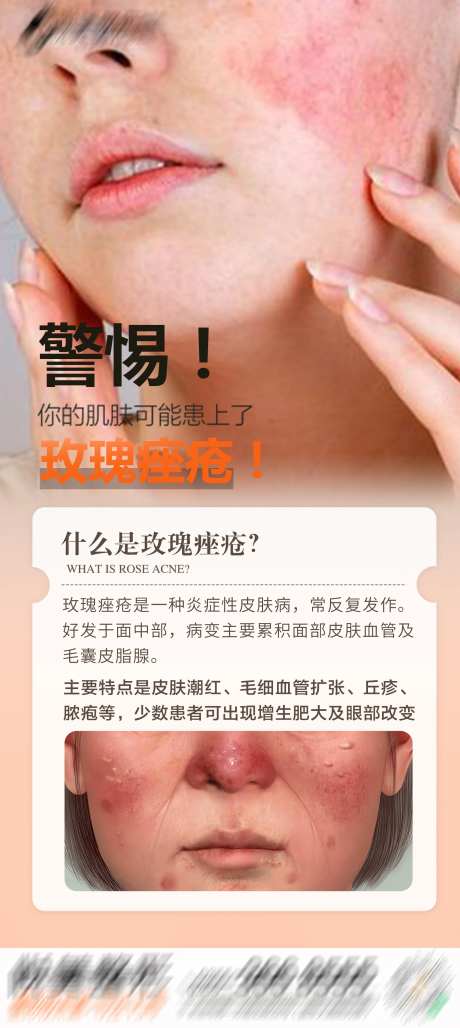 玫瑰痤疮科普海报-采灵感-https://www.cailinggan.com/