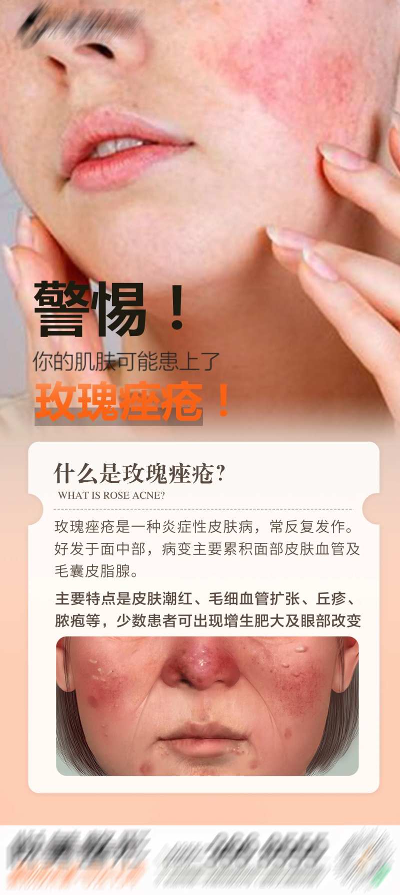 玫瑰痤疮科普海报-采灵感-cailinggan.com