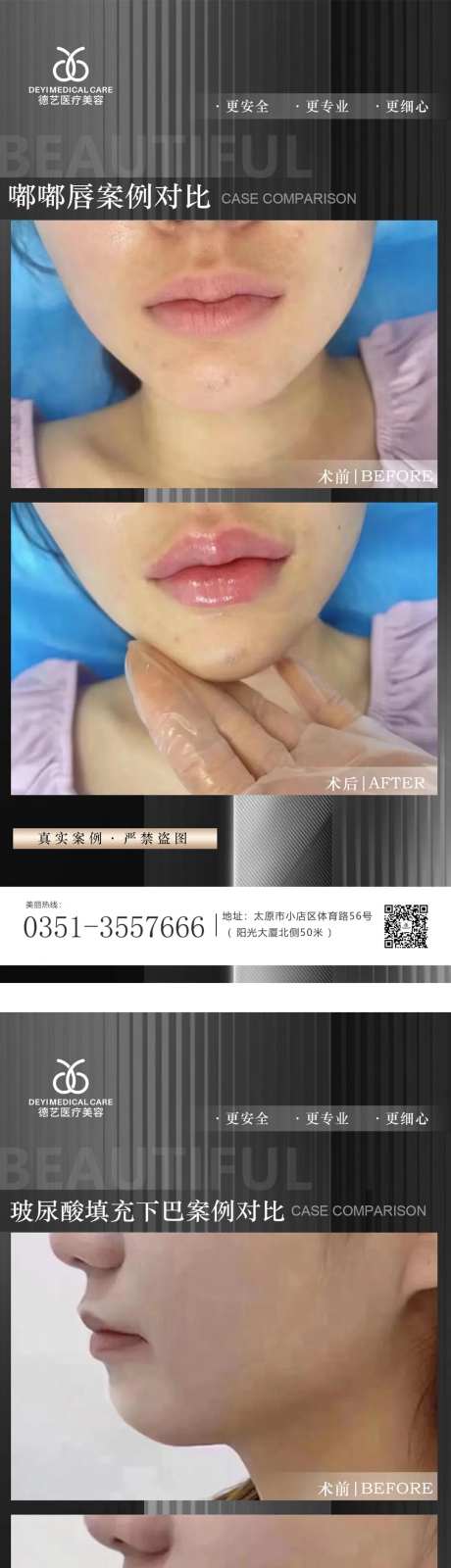 医美案例对比图-采灵感-https://www.cailinggan.com/