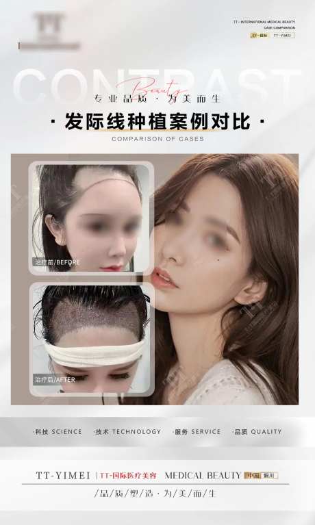 医美整形 案例对比 发际线植发-采灵感-https://www.cailinggan.com/
